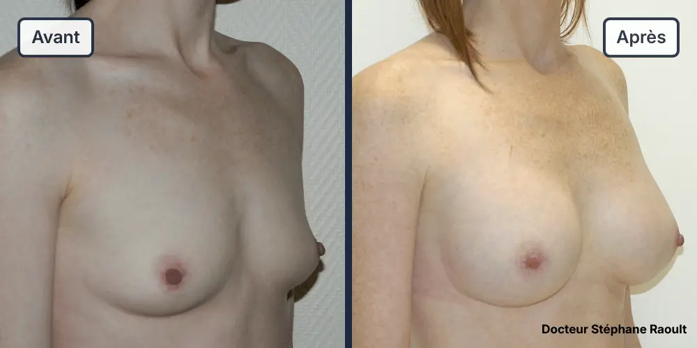Augmentation mammaire à Saint-Tropez Patient 2 - 3/4 Droit - Dr Stéphane Raoult
