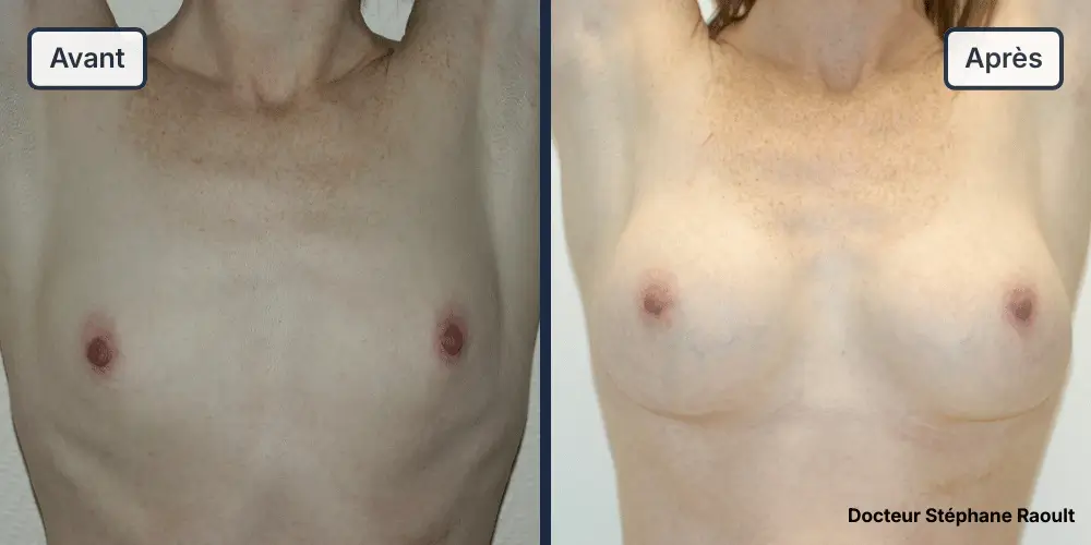 Augmentation mammaire à Saint-Tropez Patient 2 - Face bras levés - Dr Stéphane Raoult