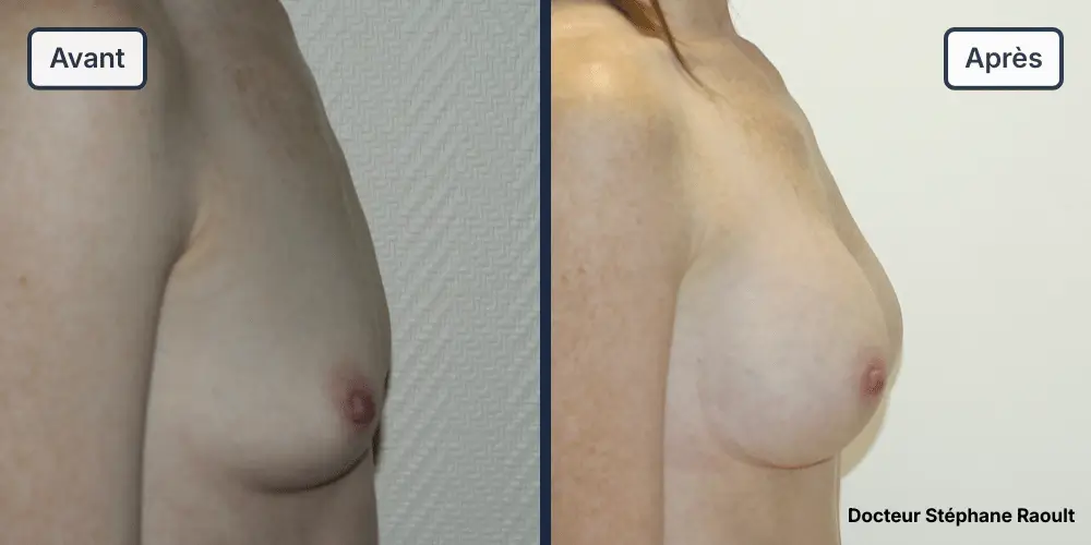 Augmentation mammaire à Saint-Tropez Patient 2 - Profil Droit - Dr Stéphane Raoult