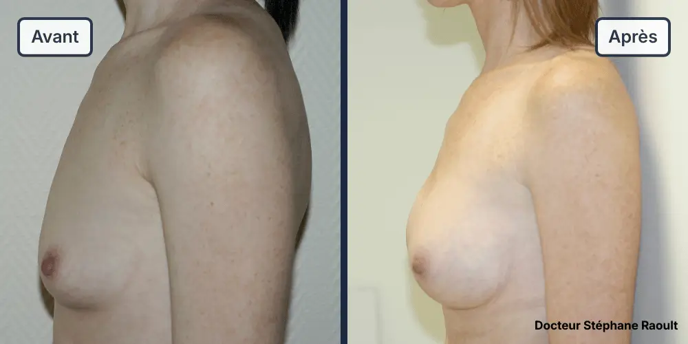 Augmentation mammaire à Saint-Tropez Patient 2 - Profil Gauche - Dr Stéphane Raoult