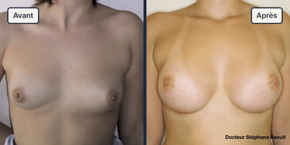 Augmentation mammaire à Saint-Tropez Patient 3 - Face - Dr Stéphane Raoult