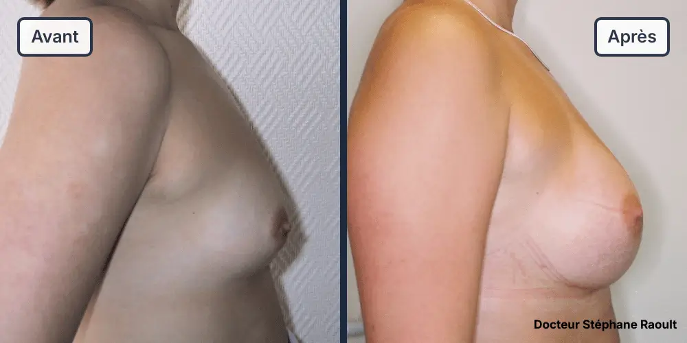Augmentation mammaire à Saint-Tropez Patient 3 - Profil Droit - Dr Stéphane Raoult