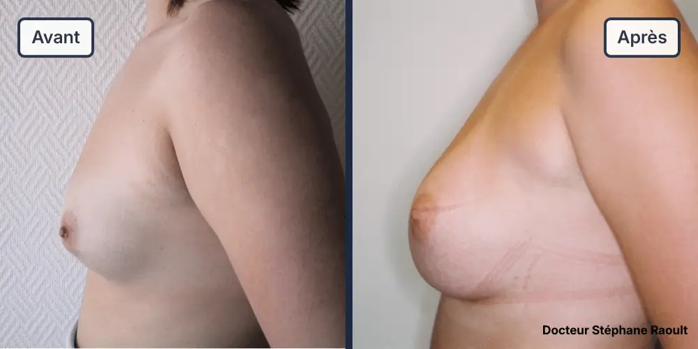 Augmentation mammaire à Saint-Tropez Patient 3 - Profil Gauche - Dr Stéphane Raoult