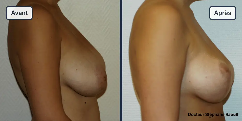 Lifting des seins à Saint-Tropez Patient 1 - Profil Droit - Dr Stéphane Raoult