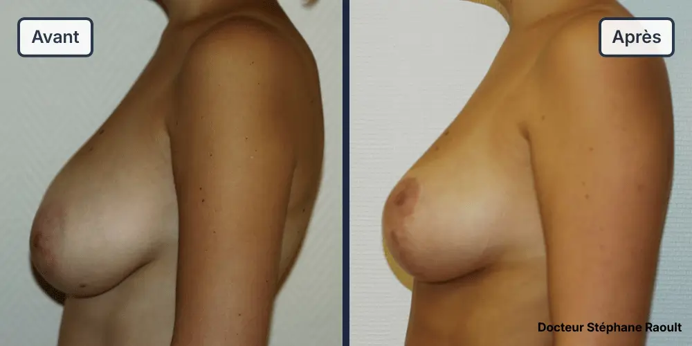 Lifting des seins à Saint-Tropez Patient 1 - Profil Gauche - Dr Stéphane Raoult
