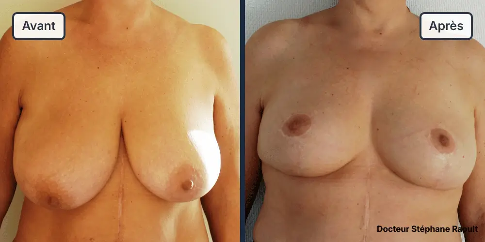 Lifting des seins à Saint-Tropez Patient 2 - Face - Dr Stéphane Raoult