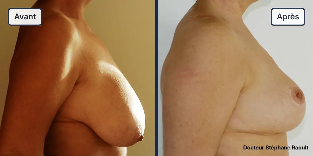 Lifting des seins à Saint-Tropez Patient 2 - Profil Droit - Dr Stéphane Raoult
