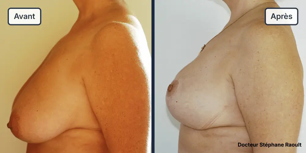 Lifting des seins à Saint-Tropez Patient 2 - Profil Gauche - Dr Stéphane Raoult